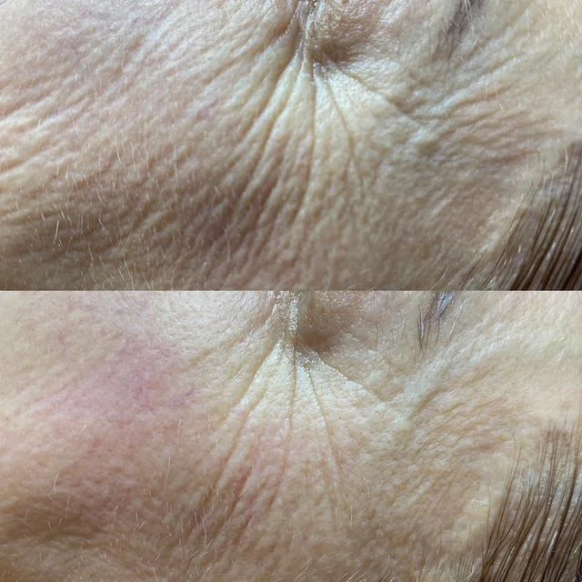 Microneedling Behandlung Zossen - Hautverbesserung vorher nachher
