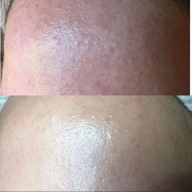 Diamant Mikrodermabrasion Behandlung Kosmetikstudio Jeannette Zossen